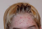 lavande acne