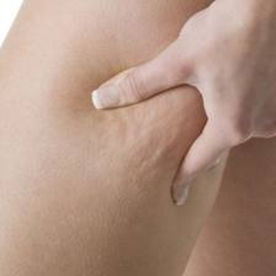 Endermologie Cellulite