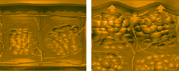 Endermologie cellulite