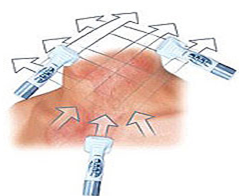 Endermologie littekens
